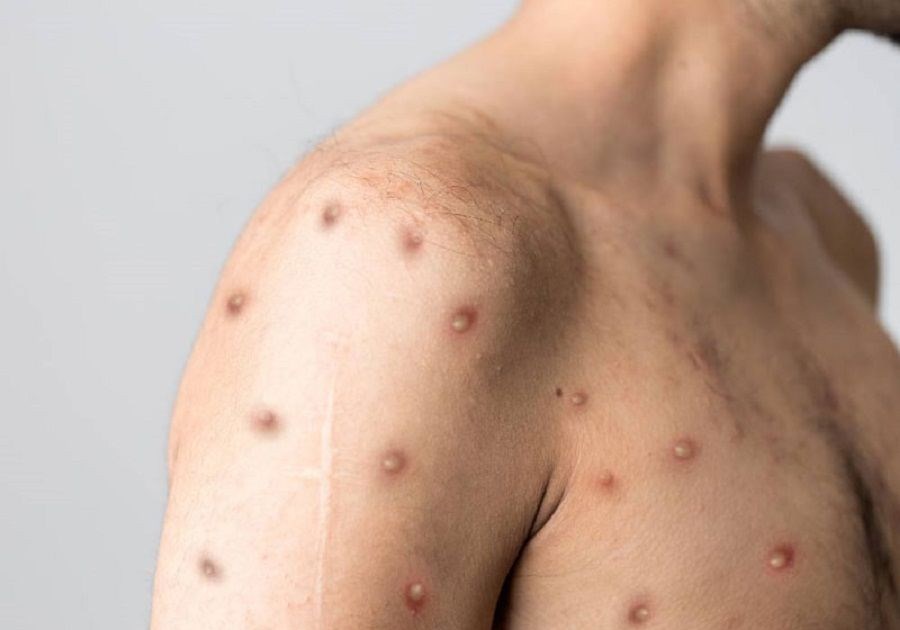 Bộ Y tế hướng dẫn cách phòng ngừa lây nhiễm bệnh đậu mùa khỉ tại cơ sở y tế