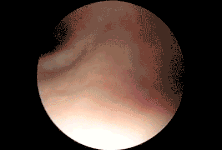 Khoảnh khắc gây sốc khi con gián chui vào trong tai người đàn ông